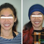 Before and after of smile makeover