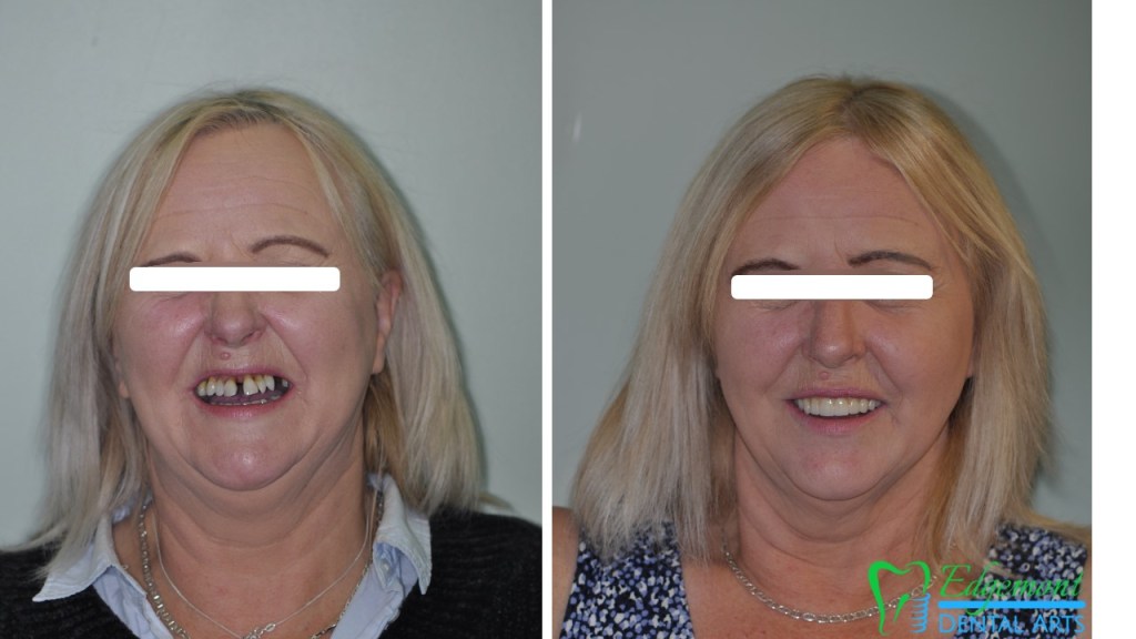 Before and after of smile makeover